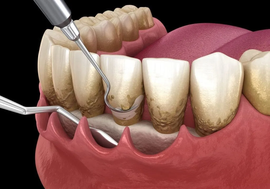 Raspagem Periodontal